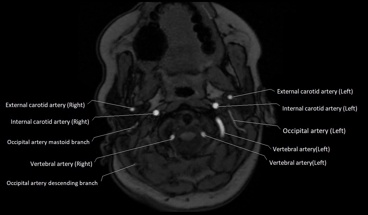 Carotid artery anatomy axial 3T image 9.jpg